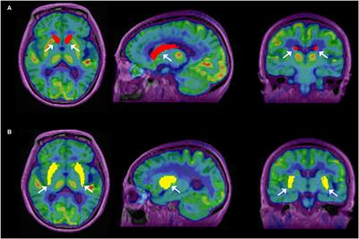 Impact of TOF on Brain PET With Short-Lived 11C-Labeled Tracers Among Suspected Patients With AD/PD: Using Hybrid PET/MRI